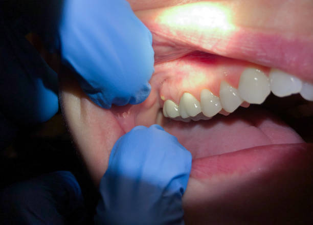 Best Tooth Infection Emergency Dentist  in College Place, WA