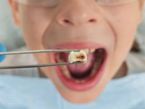 Best Chipped Tooth Repair Near Me  in College Place, WA